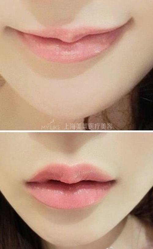 玻尿酸丰唇的价格是怎样的