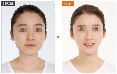 打瘦脸注意事项