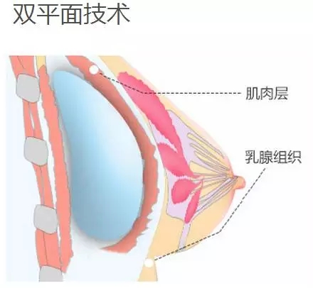 美莱私人设计丰胸 打造性感美胸胸