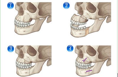 突嘴究竟需不需要做手术？